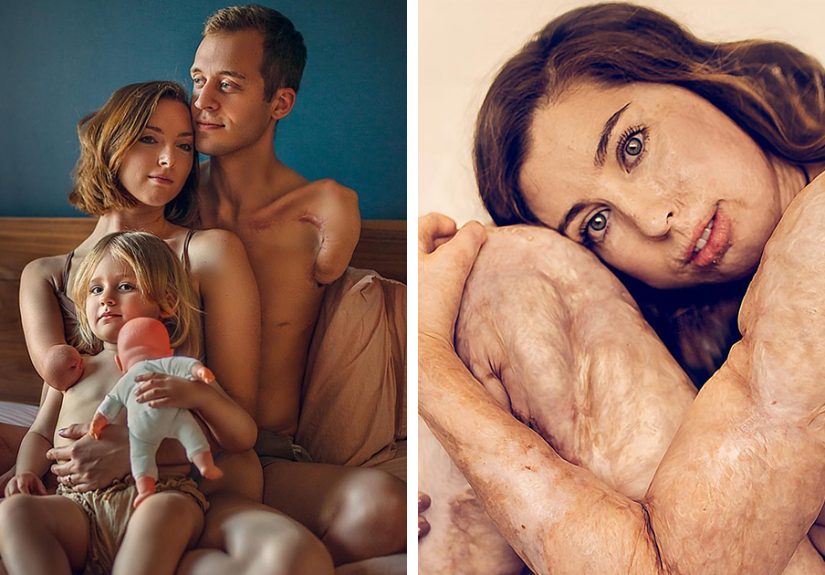 “Changing the Conversation”: 12 Raw Stories Behind These People’s Unique Appearances Captured In A Photography Project By Sujata Setia