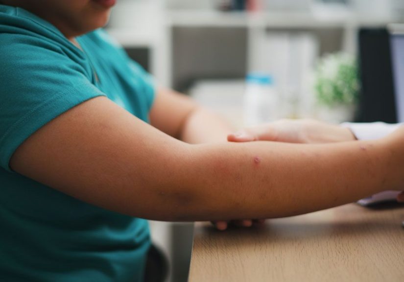 Skin Picking and ADHD: Is There a Link?