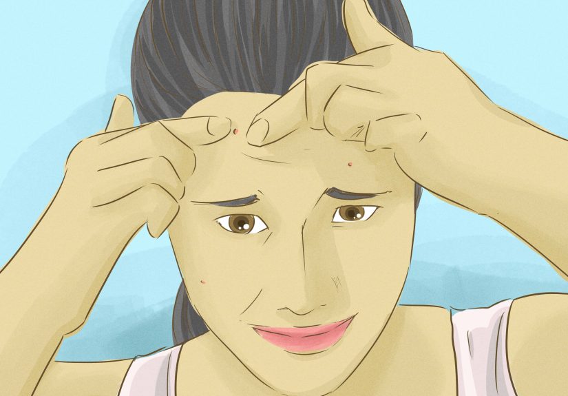 6 Ways to Reduce Acne Scars with Home Remedies