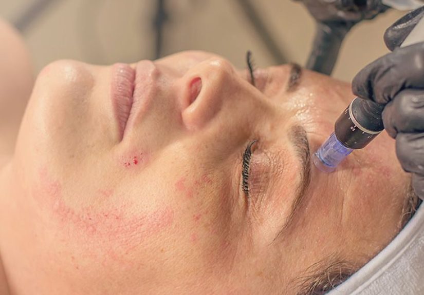 Hidradenitis suppurativa scars: Treatments, creams, and surgery