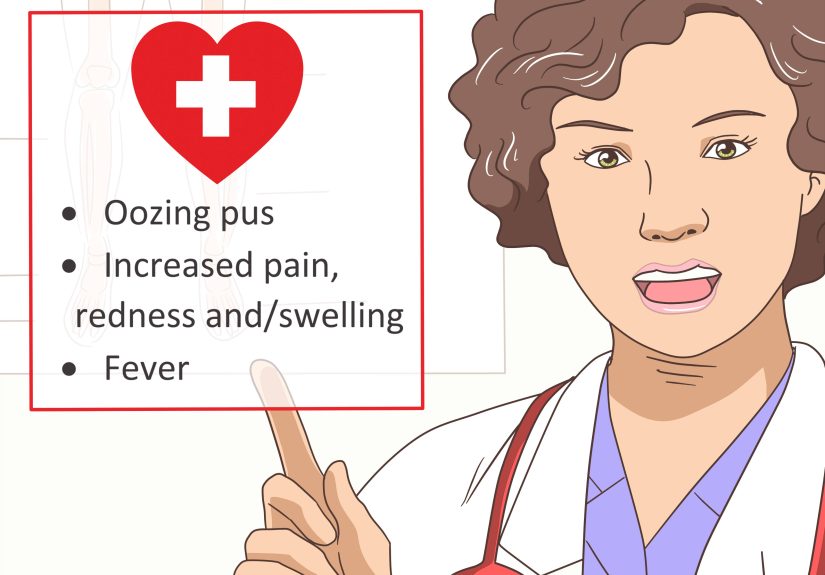 How to Treat a Blistering Burn on Your Finger: 14 Steps