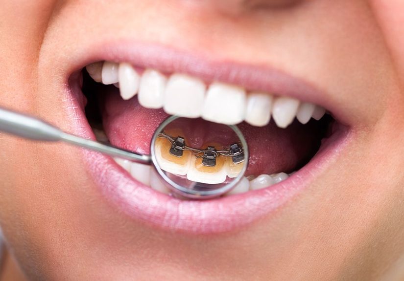 Lingual Braces: Pros and Cons, Cost, Comfort, Lisping, and More
