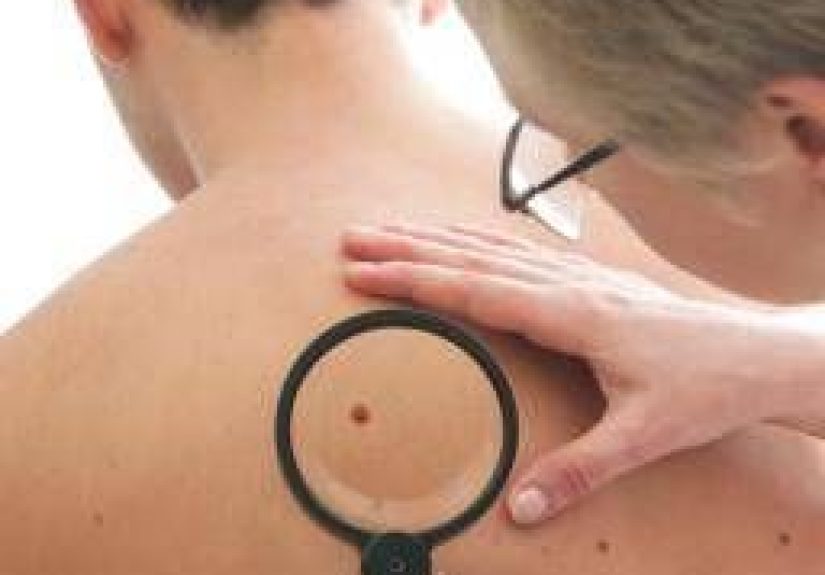 People with fewer moles may face risk of more aggressive melanoma