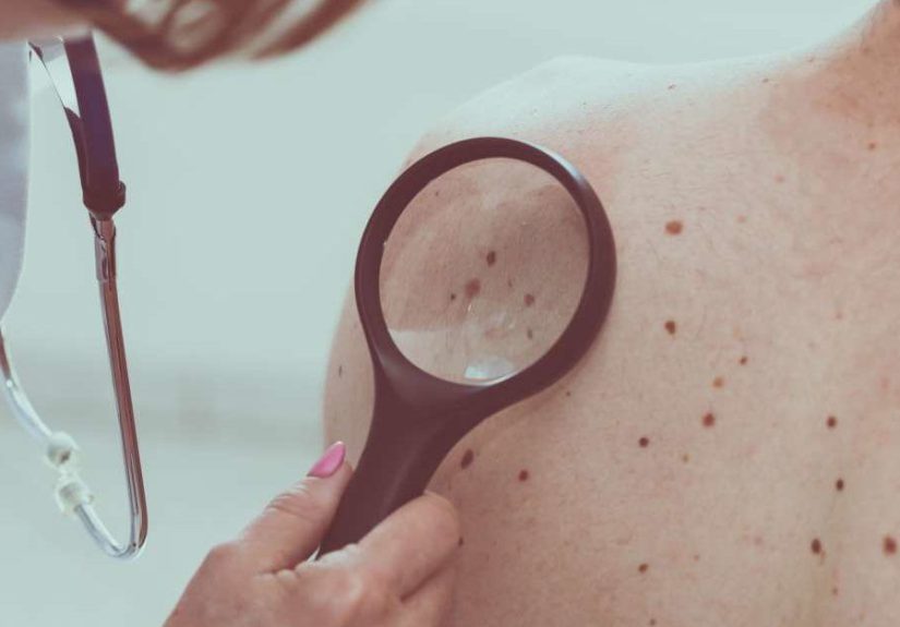 Skin cancer may predict future cancers