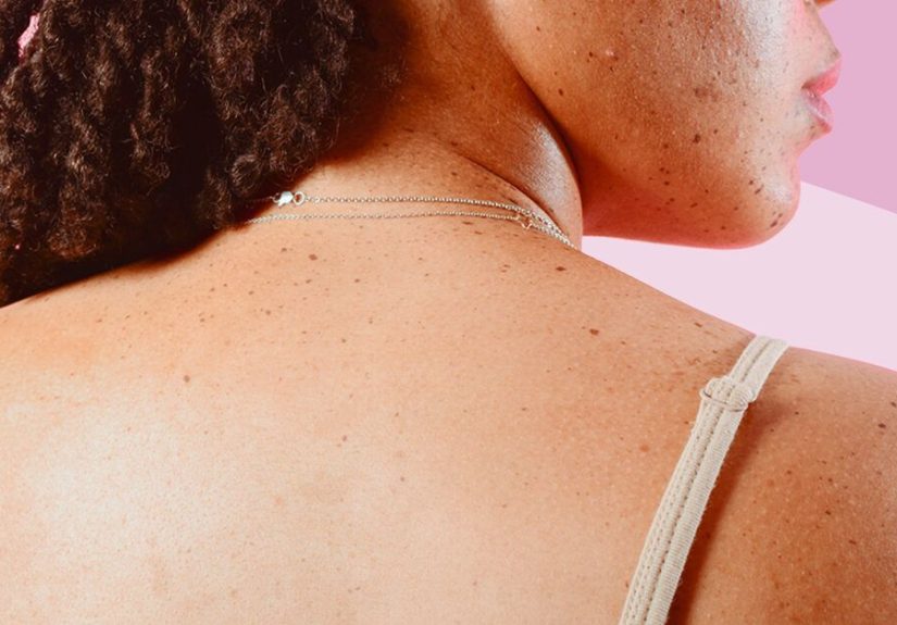 Skin Tag Removal: Home Remedies, OTC Options, and More