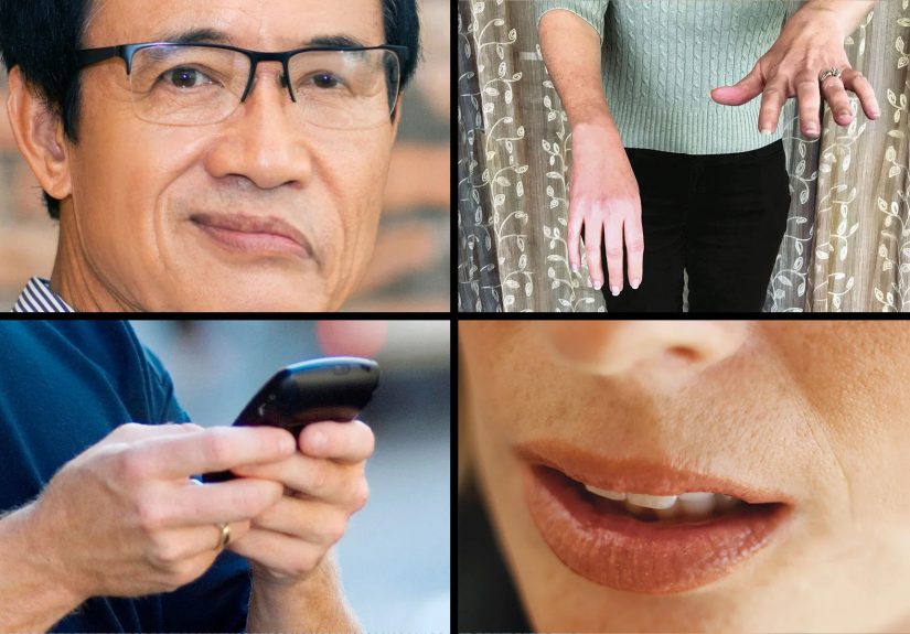 Stroke Symptoms: Signs and FAST Recognition