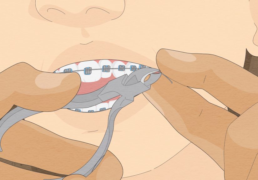 3 Ways to Temporarily Fix a Loose Wire on Your Braces