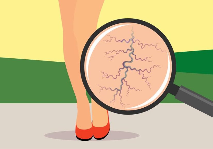 4 Tips and Remedies for Varicose Veins