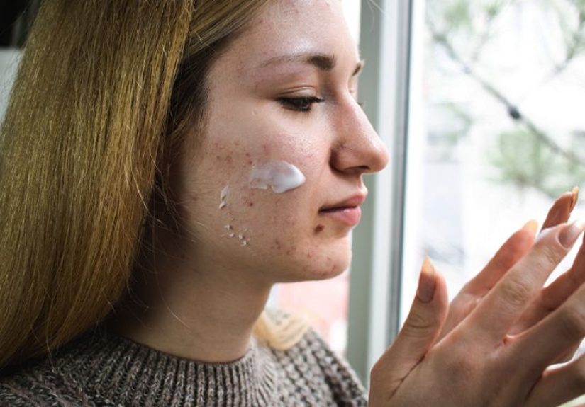 6 Ways to Help Treat Acne When You Also Have Dry Skin