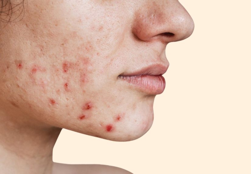 Acne Face Map: What These Breakouts Mean