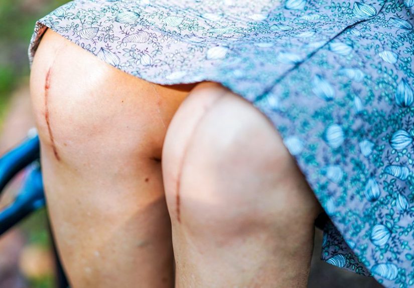 After Total Knee Replacement: The Recommendations You Need to Follow