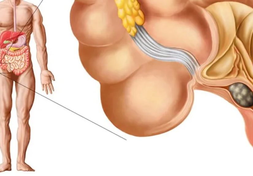 Appendicitis Causes, Complications, and Risk Factors