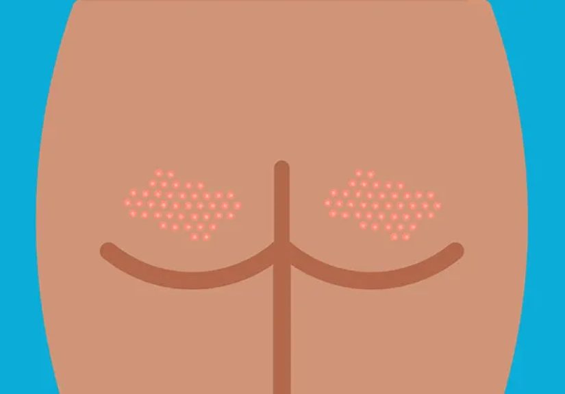 Butt Acne: How to Get Rid of the Bumps on Your Behind