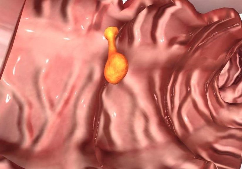 Colon polyps: Causes, symptoms, and treatment