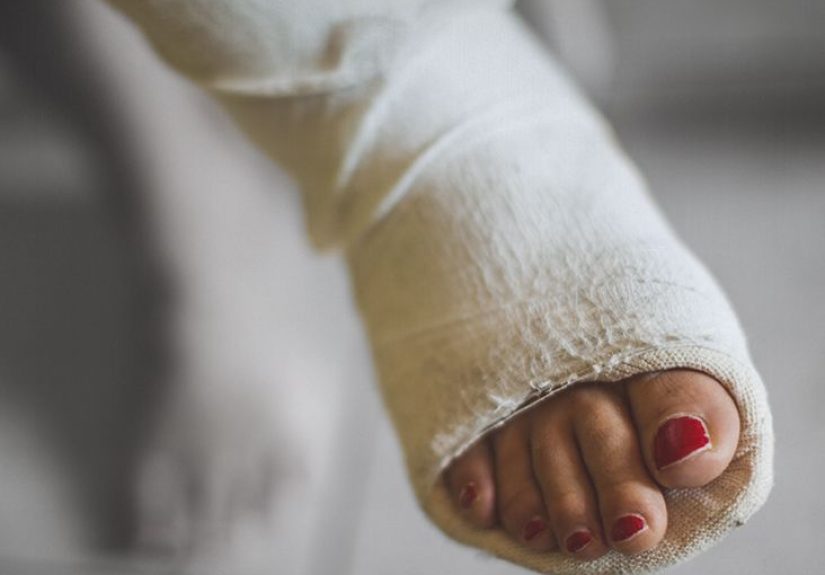 Fat embolism syndrome: Causes, symptoms, treatment