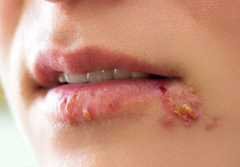 Herpes: SÃ­ntomas, causas y tratamiento
