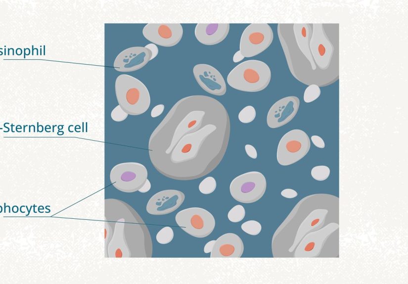 Hodgkin vs Non-Hodgkin Lymphoma: Key Differences and Treatment Options