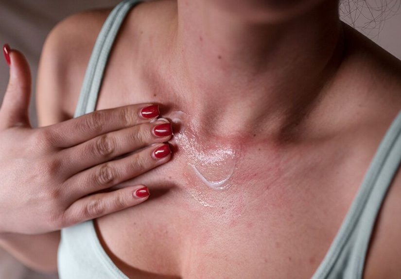 Is It a Stress Rash or Something Else?