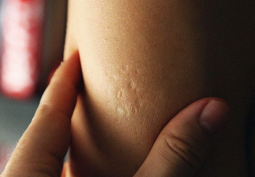 TB vaccine: Safety, efficacy, and who should get it