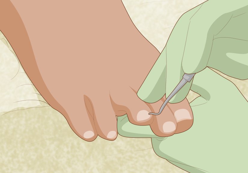 3 Ways to Prevent Ingrown Nails