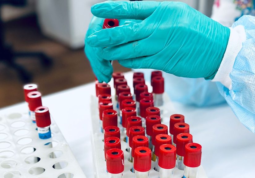 Fatty Liver Disease: Blood Tests for Diagnosis