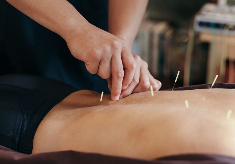 Medicare: Is Acupuncture Covered for Arthritis?