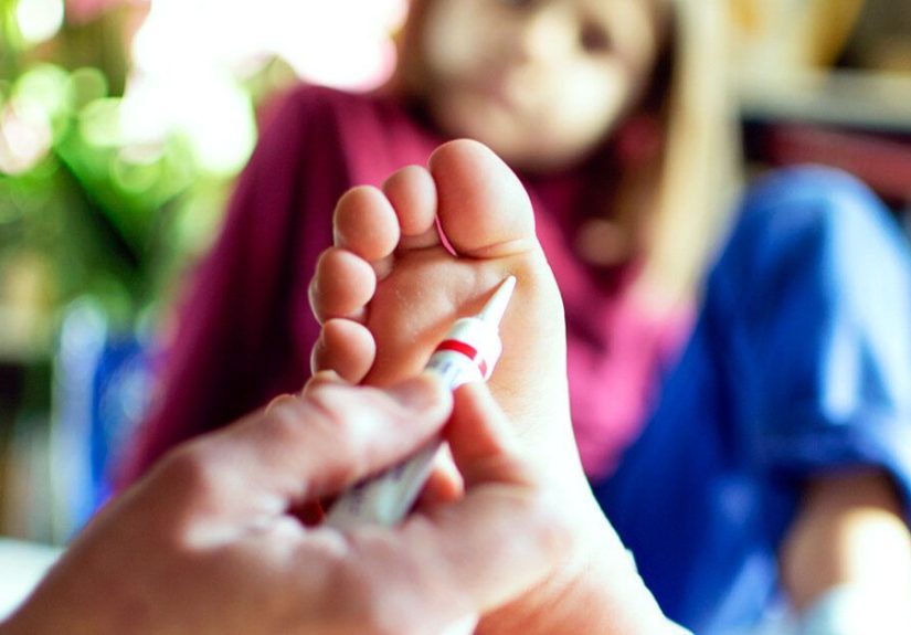 Salicylic Acid: Wart Removal Tips