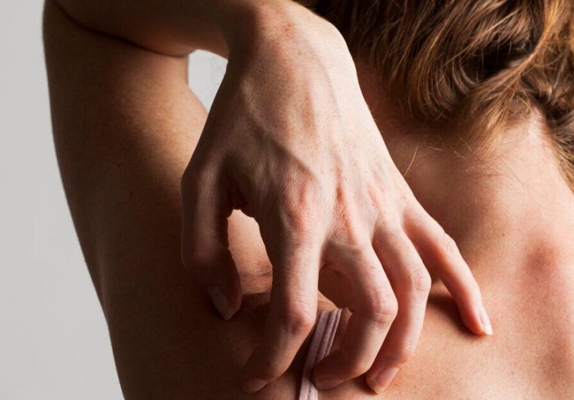 Sarna: SÃ­ntomas, imÃ¡genes, tratamientos y mÃ¡s