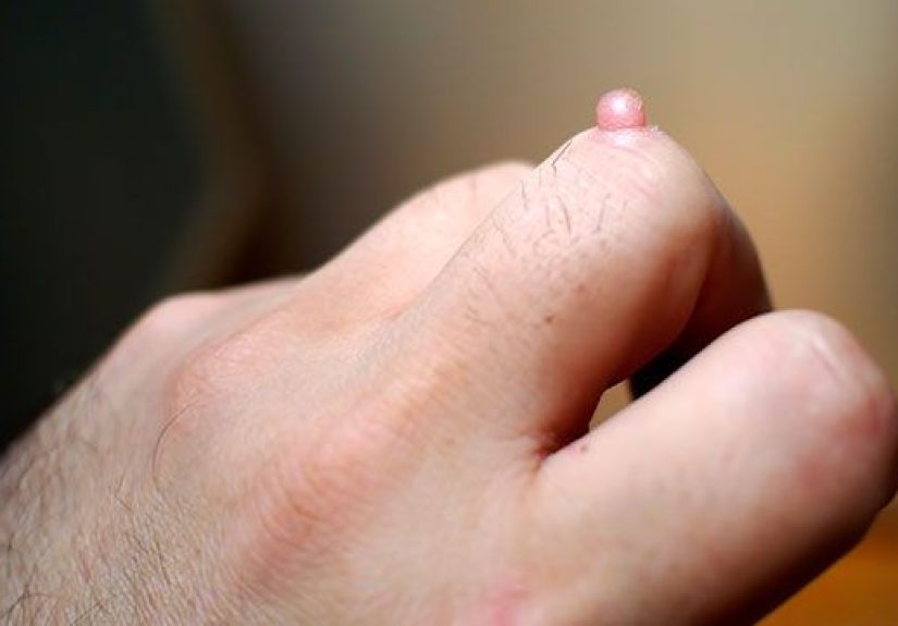 Warts: Types, Causes, Images, Treatment, and More