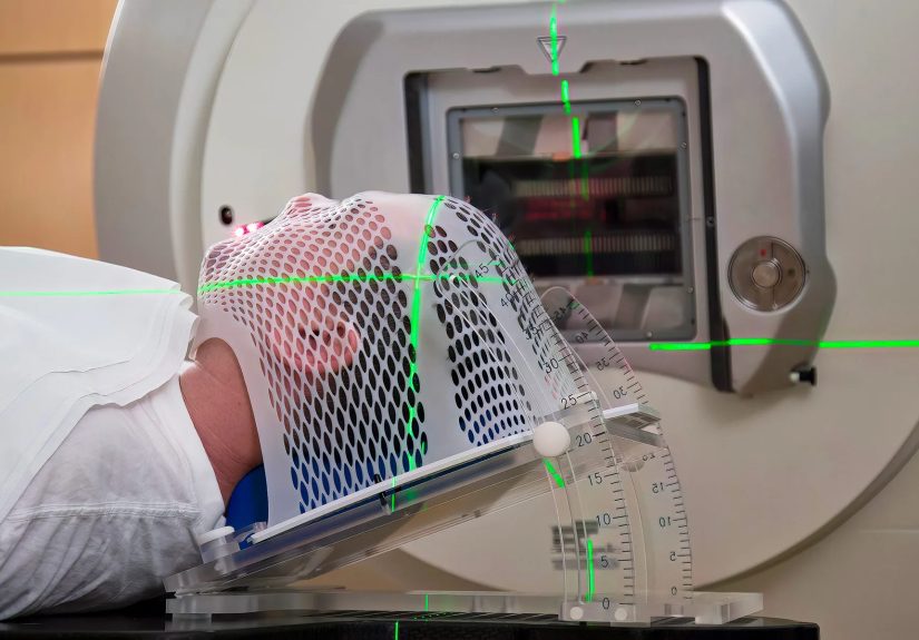 What to Expect With Radiation for Head and Neck Cancers