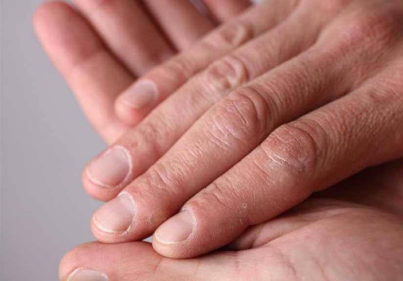 What’s Causing That Black Line on Your Nail