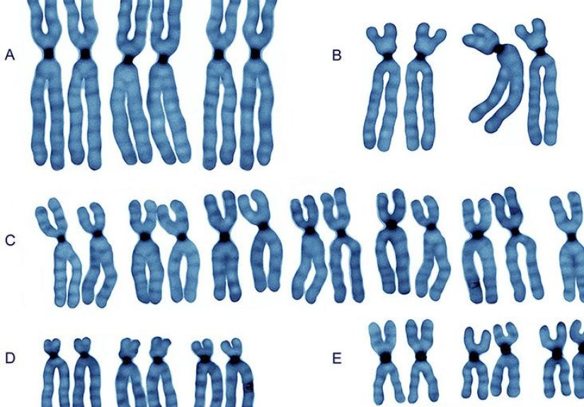 Acute Myeloid Leukemia Karyotypes: Prognosis and More