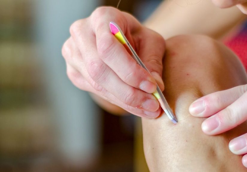 Ingrown Hair Cyst: Symptoms, Treatment, Prevention, and More