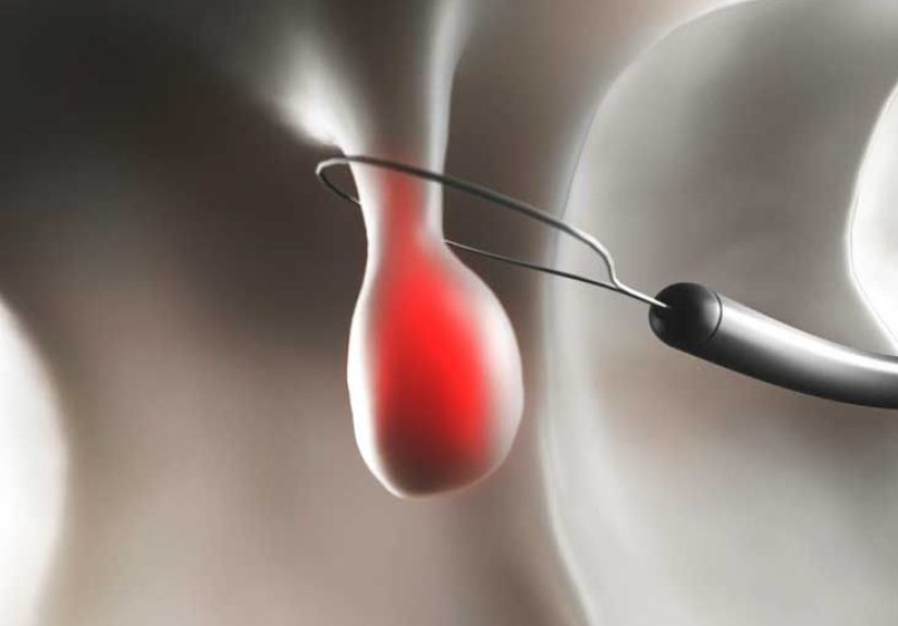 Polypectomy: Surgery Procedure and Recovery
