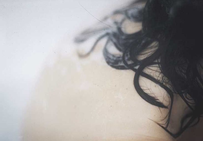Rashes and Skin Conditions Associated with HIV and AIDS