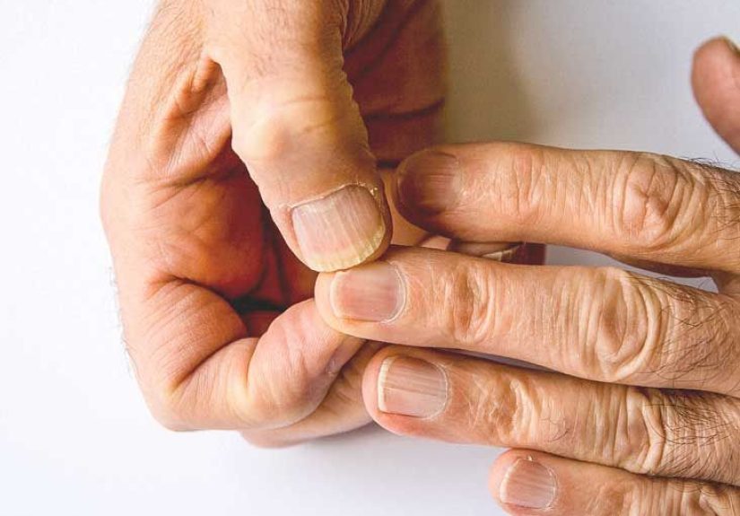 Spoon Nails: Identification, Causes, and More