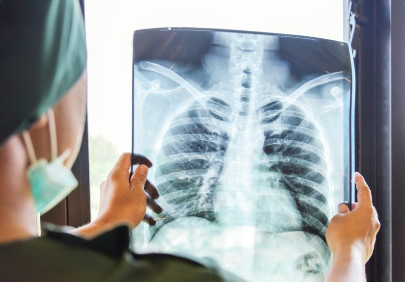 The rising threat of lung cancer in Asian American female nonsmokers