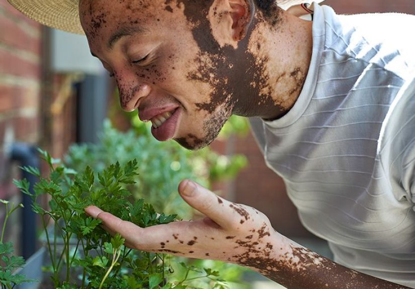 Vitiligo and Race: Prevalence, Causes, and More
